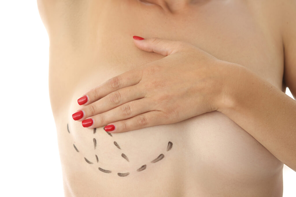 Breast Reduction in London