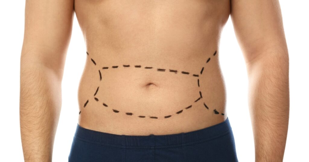 Tummy Tuck in London recovery care steps illustration