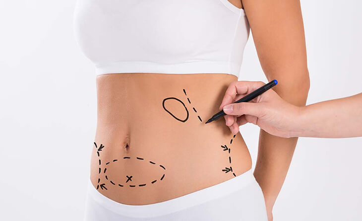 Lipoabdominoplasty in London