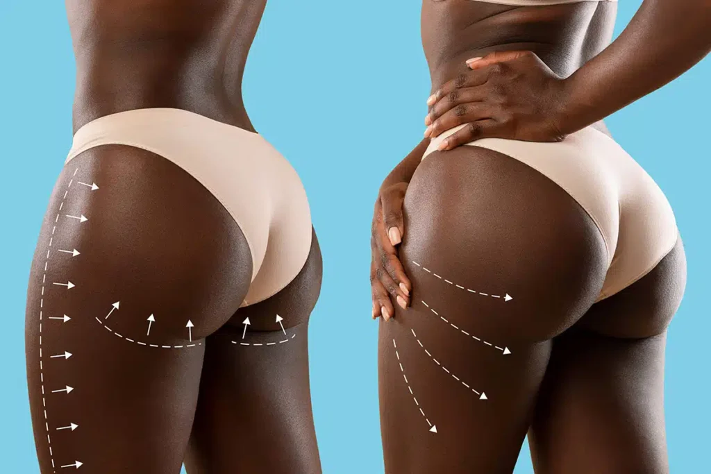 Brazilian Buttocks Lift in London