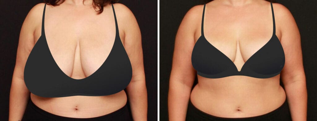 Breast Uplift in London