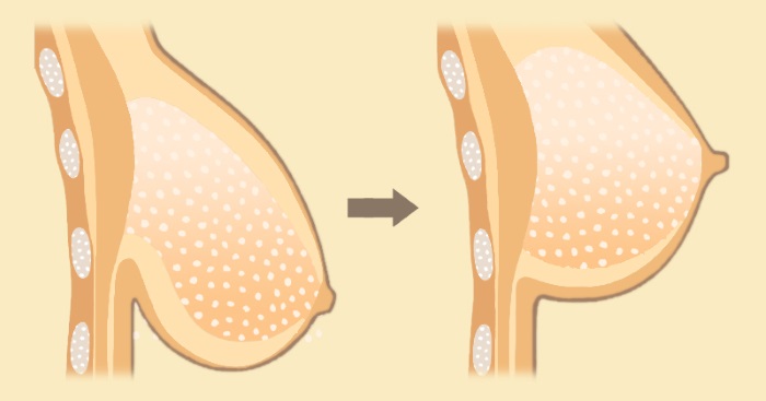 Breast Uplift in London