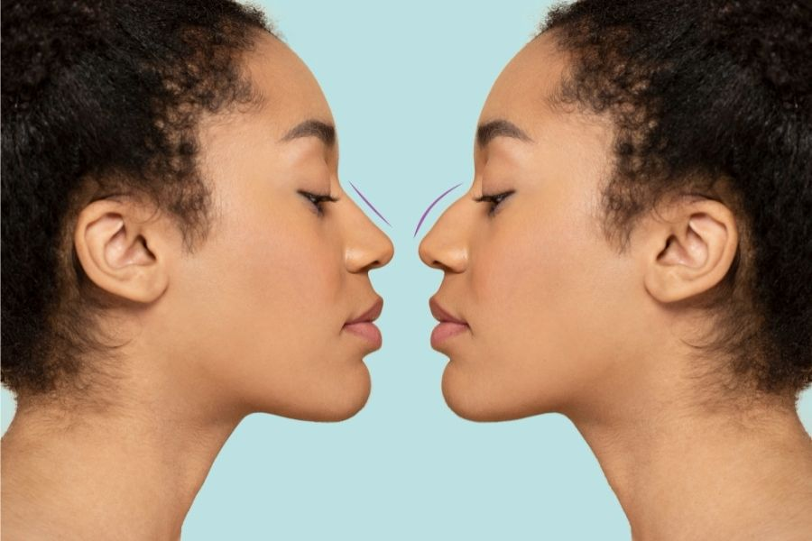 Septorhinoplasty in London