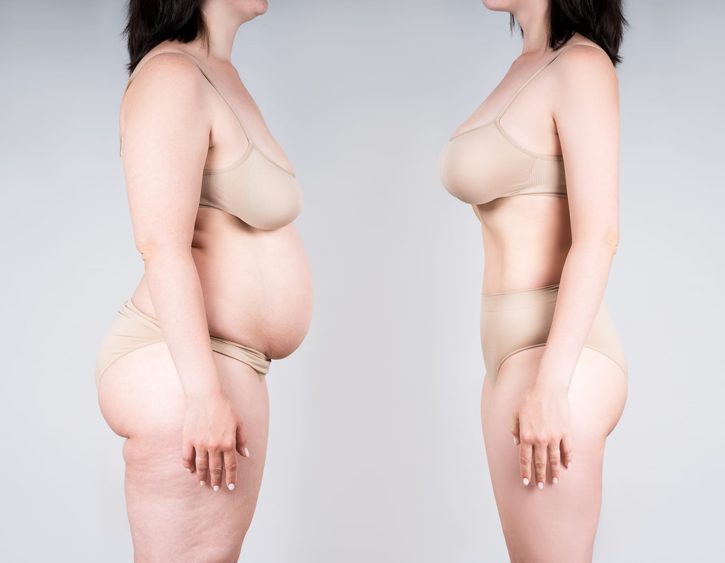 Mommy Makeover in London